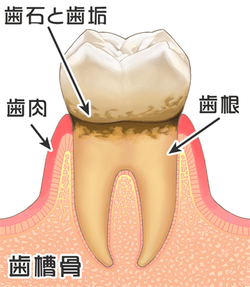 痛み 歯茎 の 歯茎がぷっくり…でも「痛くないから大丈夫」はとても危険！