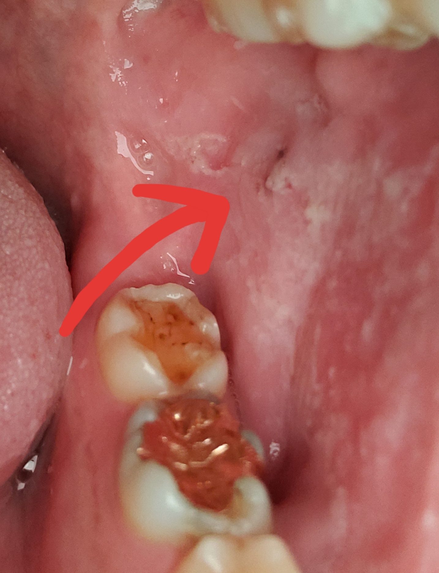 裏 舌 口内炎 原因 の 舌にできる口内炎。外的・内的要因を理解し予防しよう Doctors