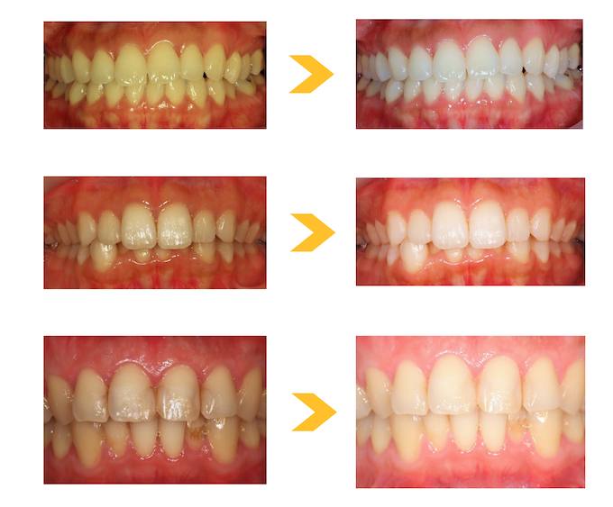ホームホワイトニングの症例紹介